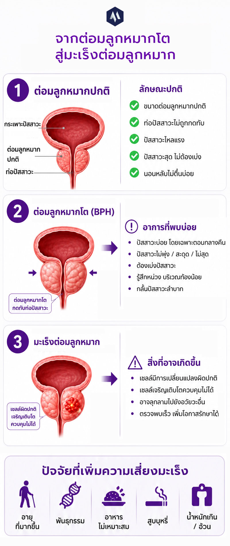 สาเหตุและการรักษาต่อมลูกหมากโต